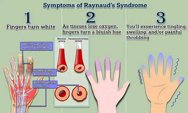 Regulatory Advances May Bring Relief for Raynaud's Patients
