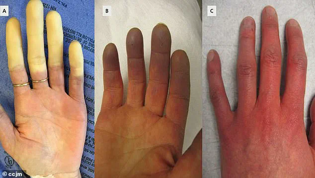 Regulatory Advances May Bring Relief for Raynaud's Patients
