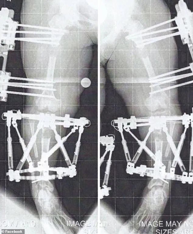 Chandler Crews: 'Living with Achondroplasia Has Been a Journey of Resilience and Advocacy'