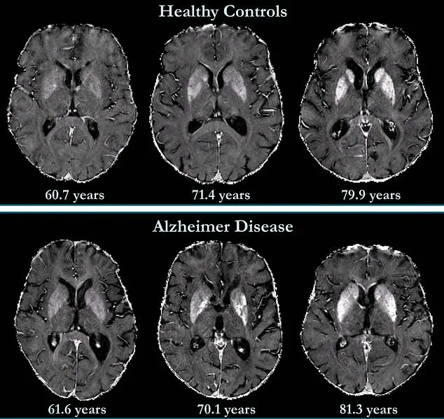 Breakthrough in Dementia Prediction: New Brain Imaging Technique Could Detect Alzheimer’s Years Before Symptoms Appear