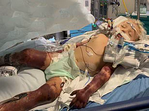 Study Links Type 2 Diabetes to Doubled Sepsis Risk, Highlighting Need for Enhanced Infection Prevention Strategies