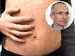 Tragic Case in LA County Highlights Measles-Linked SSPE Risks and Vaccination Urgency, Says Health Officials