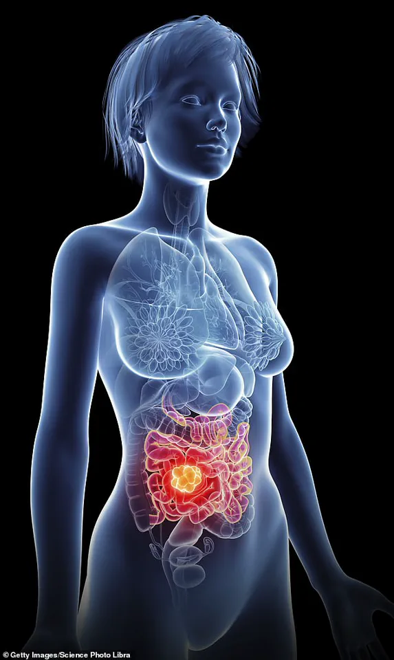 Rising Bowel Cancer Rates in Young Adults Prompt Expert-Backed Lifestyle Changes