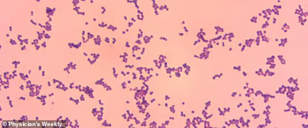 Unexpected Danger of Group G Streptococcus: A Growing Public Health Concern as Experts Warn of Life-Threatening Infections