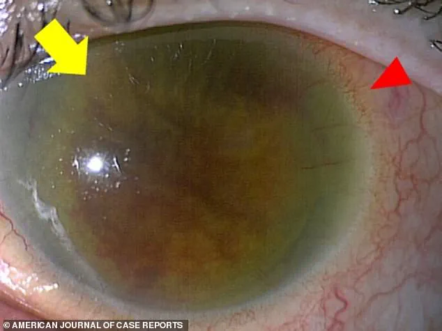 Unexpected Danger of Group G Streptococcus: A Growing Public Health Concern as Experts Warn of Life-Threatening Infections