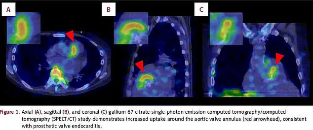 Unexpected Danger of Group G Streptococcus: A Growing Public Health Concern as Experts Warn of Life-Threatening Infections