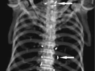 Discovery of Hundreds of Gold Threads in Woman's Knees Sparks Safety Concerns Over Alternative Acupuncture Treatment