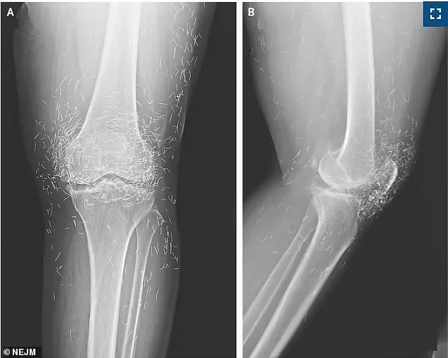 Discovery of Hundreds of Gold Threads in Woman's Knees Sparks Safety Concerns Over Alternative Acupuncture Treatment