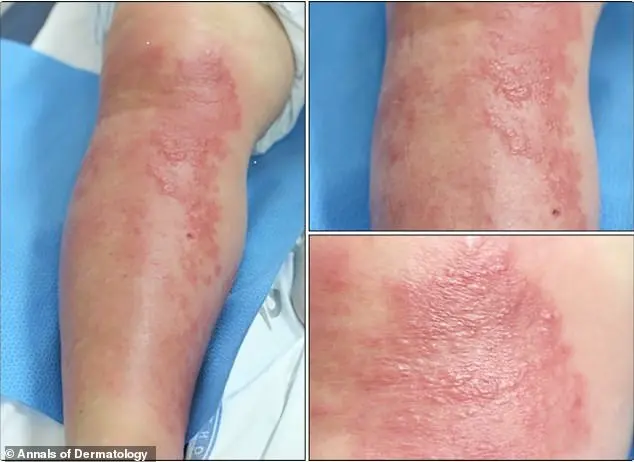 Discovery of Hundreds of Gold Threads in Woman's Knees Sparks Safety Concerns Over Alternative Acupuncture Treatment