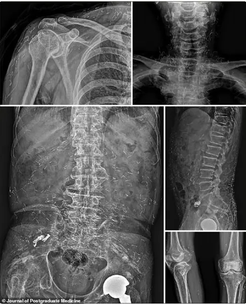 Discovery of Hundreds of Gold Threads in Woman's Knees Sparks Safety Concerns Over Alternative Acupuncture Treatment