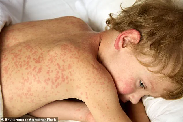 Measles Outbreak at Four Major US Airports Sparks Urgent Health Advisories as Holiday Travelers Warned