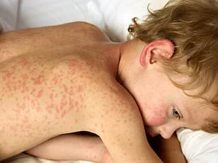 South Carolina Health Officials Issue Urgent Warning as Measles Cases Surge to 434 Since September