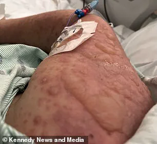 Severe Adverse Reaction to Lamotrigine Leaves Woman with Extensive Skin Loss