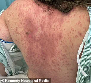 Severe Adverse Reaction to Lamotrigine Leaves Woman with Extensive Skin Loss
