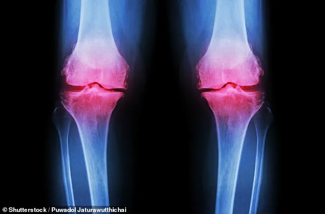 Stanford Researchers Develop Novel Drug to Reverse Age-Related Cartilage Loss, Offering New Hope for Knee Arthritis Prevention