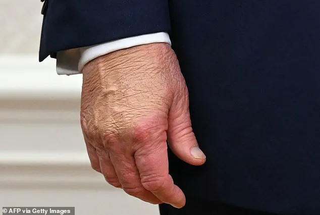 White House Clarifies Origin of President Trump's Hand Bruises Sustained During Davos Signing Ceremony