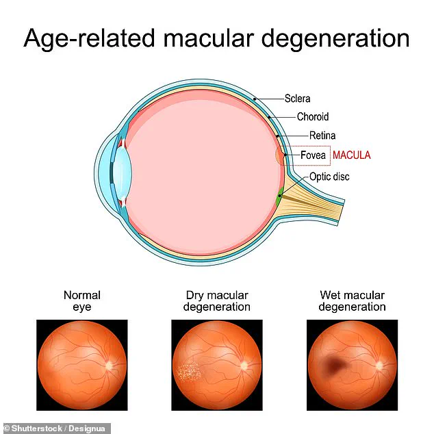 Study Reveals Metformin's Unexpected Role in Reducing AMD Progression