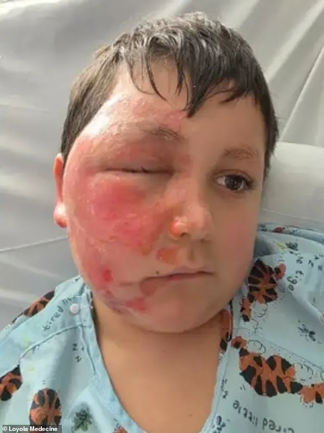 Nine-Year-Old Suffers Severe Burns in TikTok Microwave Challenge