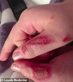 Nine-Year-Old Suffers Severe Burns in TikTok Microwave Challenge