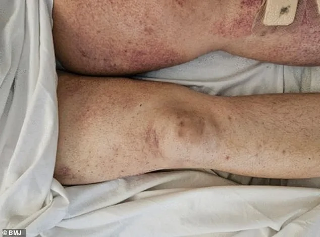 Scurvy Resurgence: Alarms Over Surge Linked to Poor Diets and Weight Loss Drugs