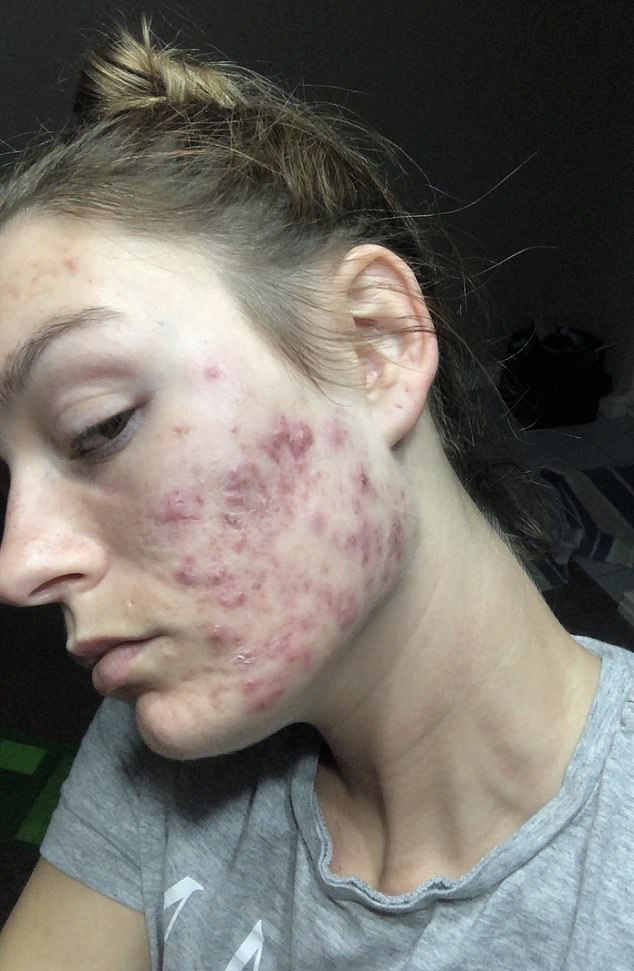 Tara Dekker's Hidden Battle: The Emotional Toll of Adult Acne