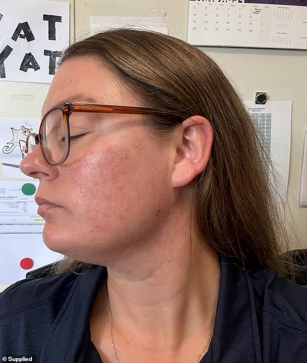 Tara Dekker's Hidden Battle: The Emotional Toll of Adult Acne