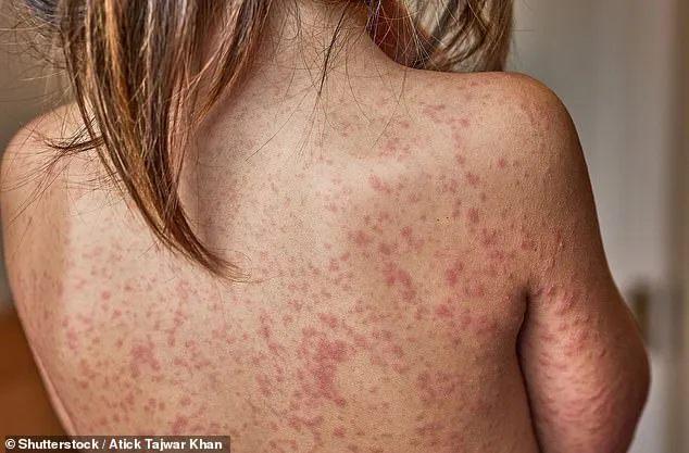 London on Brink of Measles Outbreak: 34 Cases in Enfield as Unvaccinated Children Fuel Crisis
