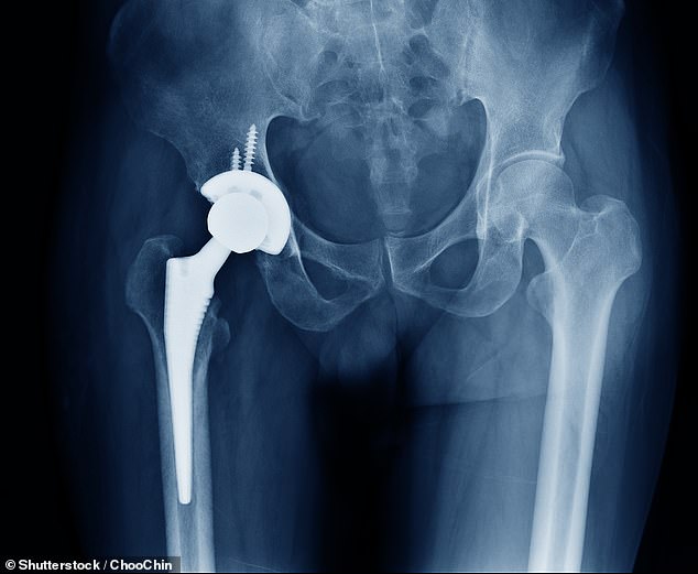 NHS Hip and Knee Replacements Face Cancellations Over Bone Cement Shortage