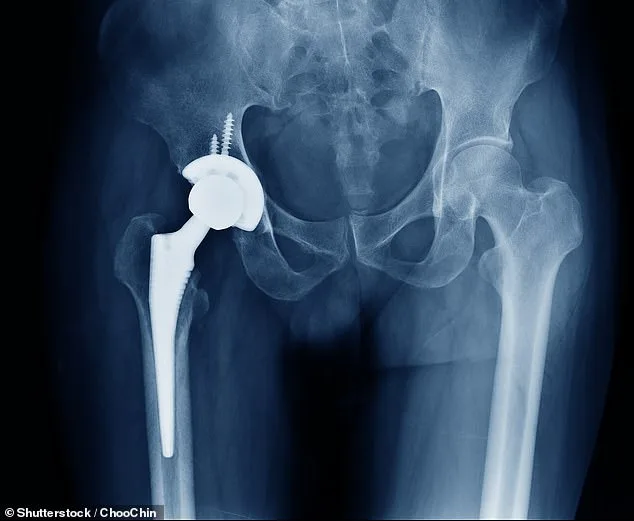 NHS Hip and Knee Replacements Face Cancellations Over Bone Cement Shortage