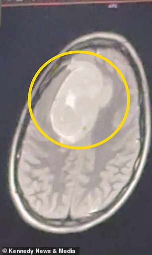 From Dismissal to Medical Crisis: Gillian Keating's Journey with Severe Headaches