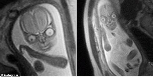 Fetal MRI Images Fuel Debate on Safety in Pregnancy