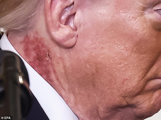Trump's Rash Attributed to Preventative Treatment, Says Doctor