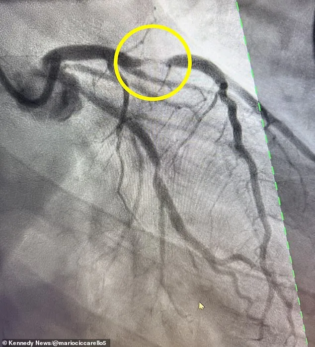 Fit Ultra-Marathoner's Near-Death Experience: Ignoring Chest Pain Led to 95% Heart Blockage