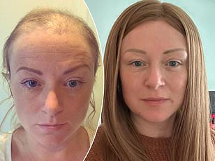 Grey Hair May Hold Key to Early Melanoma Detection, Reveals Study in Nature Cell Biology