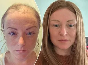 Grey Hair May Hold Key to Early Melanoma Detection, Reveals Study in Nature Cell Biology