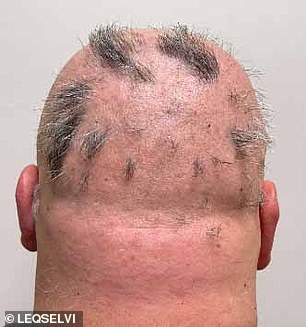 UK Approves Groundbreaking Treatment for Severe Alopecia Areata