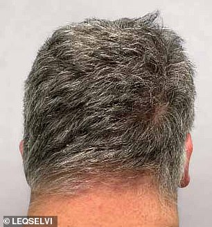 UK Approves Groundbreaking Treatment for Severe Alopecia Areata