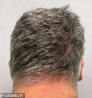 UK Approves Groundbreaking Treatment for Severe Alopecia Areata