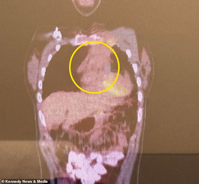 When Burnout Became Lupus: A Student's Path from Ignored Symptoms to Diagnosis