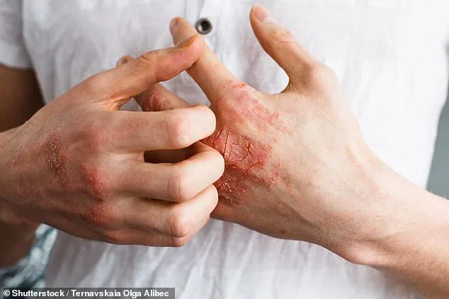 FDA Approves Groundbreaking Oral Medication for Psoriasis: Icotyde Offers New Hope with Once-Daily Dosing