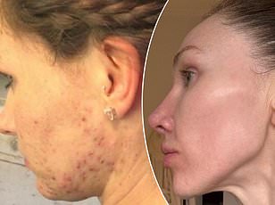 Study Finds Collagen Supplements Improve Skin Elasticity and Ease Joint Pain