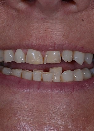 From Hidden Smiles to Confidence: How the ABC Technique Transformed Mandy Turver's Life