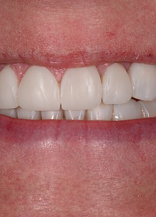 From Hidden Smiles to Confidence: How the ABC Technique Transformed Mandy Turver's Life