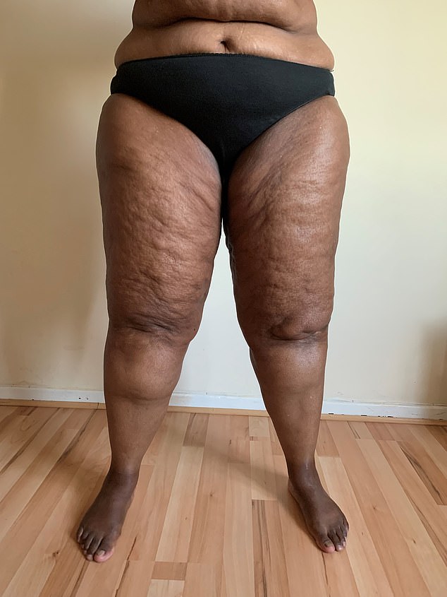 Lipoedema: The Hidden Condition Affecting 1 in 10 Women, Spotlighted by Celebs Like Doja Cat