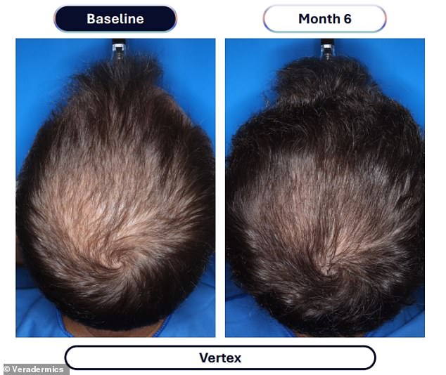 New drug quadruples hair regrowth results in clinical trials