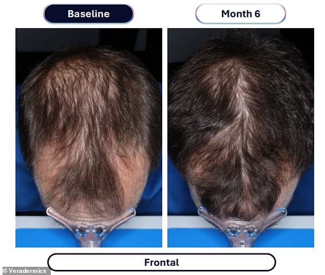 New drug quadruples hair regrowth results in clinical trials