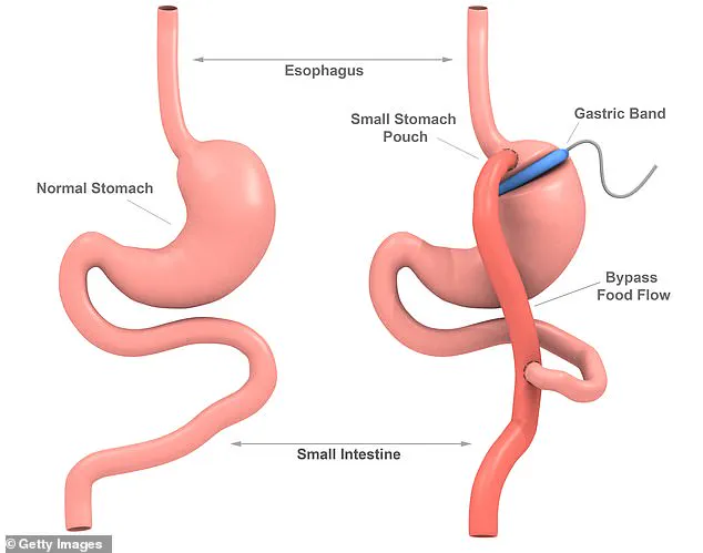 The Perils of Bariatric Surgery: My Unexpected Journey