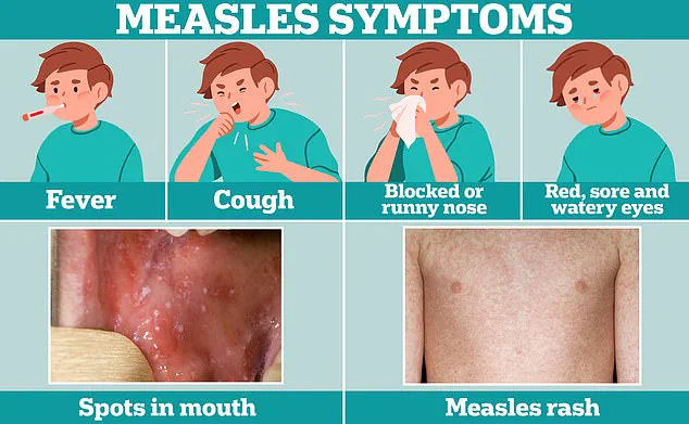 Alarm over Measles Outbreak at JFK Airport: Investigation Underway