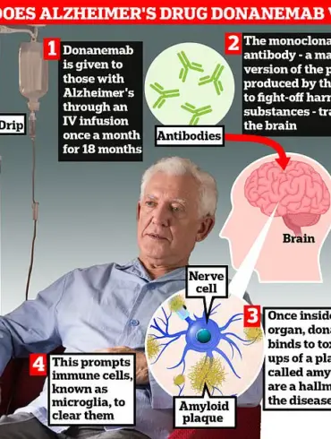 Alzheimer's Drug Donanemab: Promising Treatment or Health Risk?