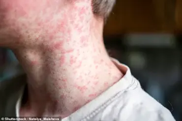 Health Officials Issue Alert Over Measles Case in Washington D.C.